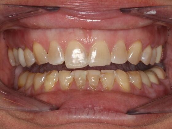 Stained, damaged teeth