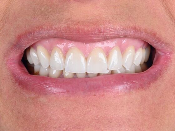 Beautiful smile after veneers and crowns